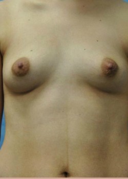 Before Image: Breast Augmentation – Case 14 - front