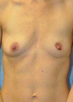Before Image: Breast Augmentation – Case 16 - front