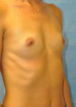 Breast Augmentation – Case 17