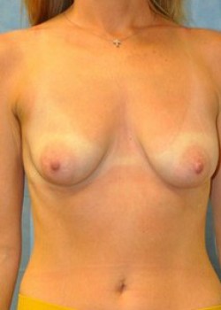 Breast Augmentation – Case 19
