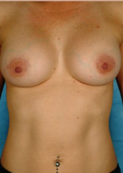 Breast Augmentation – Case 21