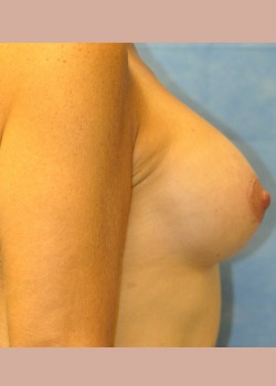 After Image: Breast Augmentation – Case 23 - other