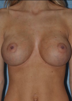 After Image: Breast Augmentation – Case 24 - front