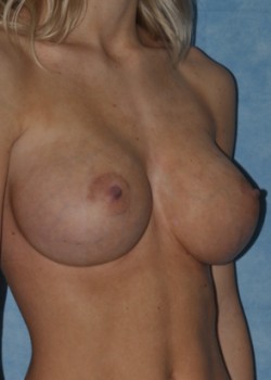 After Image: Breast Augmentation – Case 24 - other