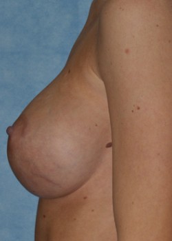 After Image: Breast Augmentation – Case 24 - other