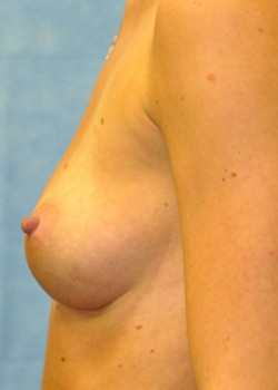 Breast Augmentation – Case 24