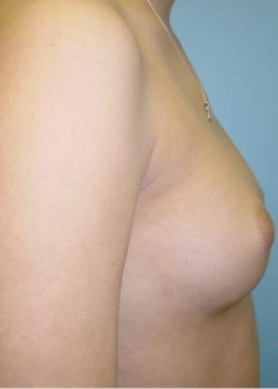 Breast Augmentation – Case 25