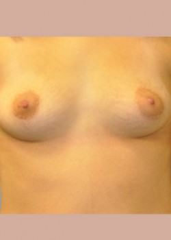 Breast Augmentation – Case 27