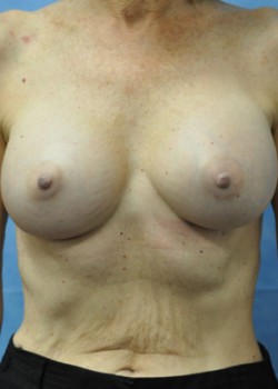 Breast Augmentation – Case 29