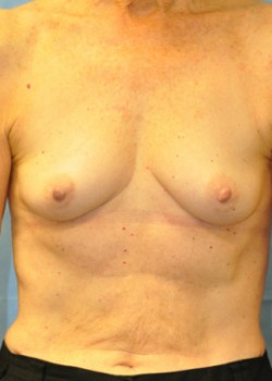 Breast Augmentation – Case 29