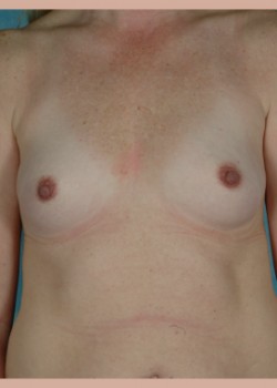 Breast Augmentation – Case 33