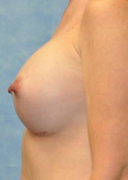 After Image: Breast Augmentation – Case 33 - other