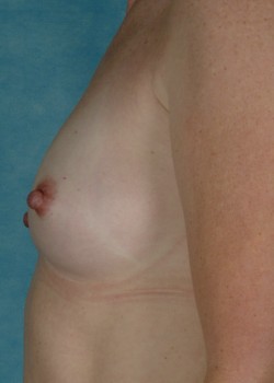 Breast Augmentation – Case 33