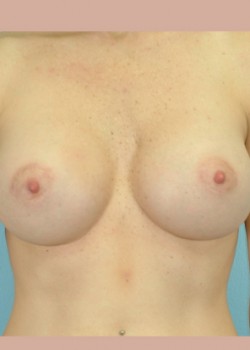 Breast Augmentation – Case 34