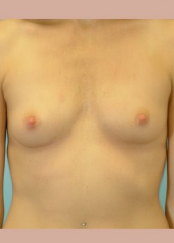 Before Image: Breast Augmentation – Case 34 - front