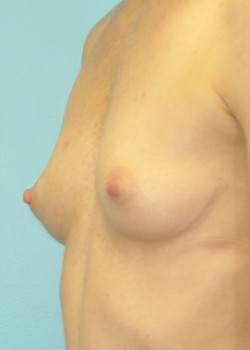 Breast Augmentation – Case 34