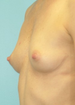 Before Image: Breast Augmentation – Case 34 - other