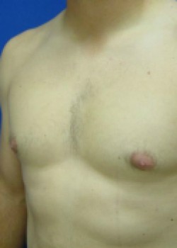 Gynecomastia – Case 1