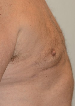 After Image: Gynecomastia – Case 2 - front