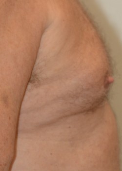 Before Image: Gynecomastia – Case 2 - front