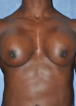 Before Image: Implant Exchange – Case 2 - front