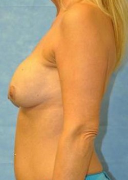 Before Image: Implant Exchange – Case 3 - left-side