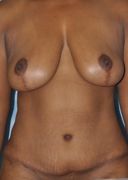 Mastopexy – Case 2