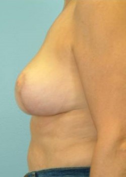 After Image: Mastopexy – Case 4 - left-side