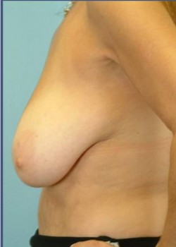 Before Image: Mastopexy – Case 4 - left-side