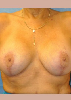 After Image: Mastopexy – Case 5 - front
