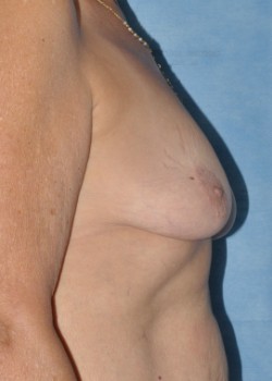 Before Image: Mastopexy – Case 5 - right-side
