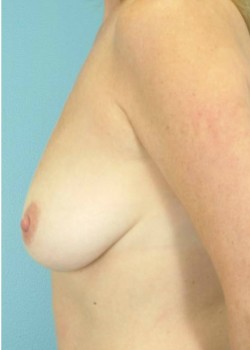 Before Image: Mastopexy – Case 7 - left-back-oblique