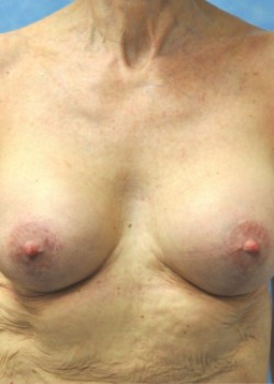 Mastopexy – Case 8