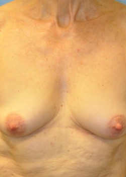 Mastopexy – Case 8