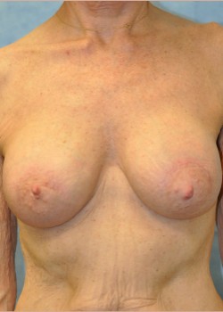 Mastopexy – Case 9