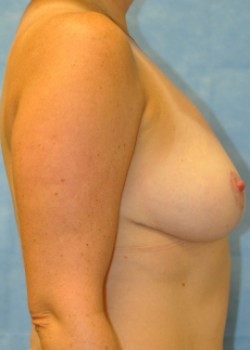 Breast Reduction – Case 1