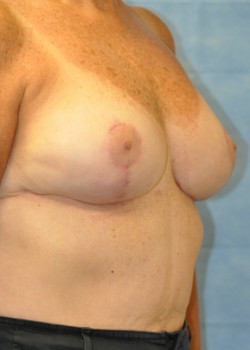 Breast Reduction – Case 2