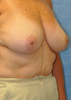 Breast Reduction – Case 2