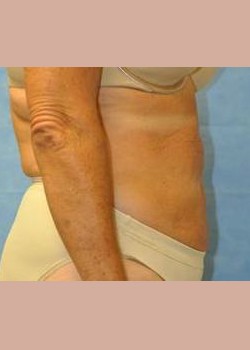 After Image: Liposuction – Case 2 - other