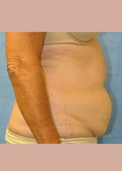 Before Image: Liposuction – Case 2 - other