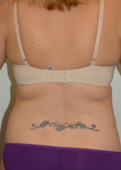After Image: Liposuction – Case 4 - front