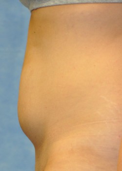 Liposuction – Case 5