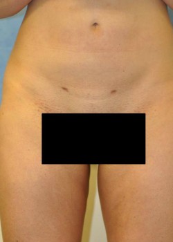 Liposuction – Case 6