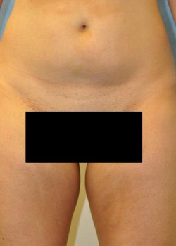 Before Image: Liposuction – Case 6