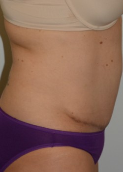 After Image: Abdominoplasty – Case 1 - other