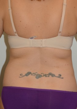 After Image: Abdominoplasty – Case 1 - back
