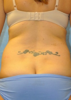 Before Image: Abdominoplasty – Case 1 - back