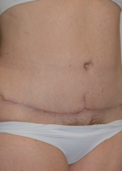 After Image: Abdominoplasty – Case 2 - other
