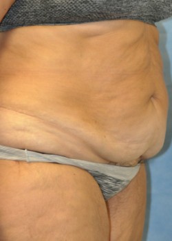 Before Image: Abdominoplasty – Case 3 - front