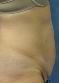 Before Image: Abdominoplasty – Case 4 - other